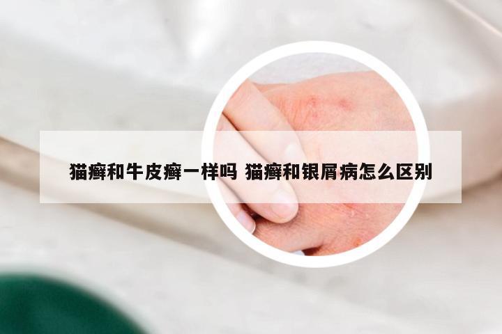 猫癣和牛皮癣一样吗 猫癣和银屑病怎么区别