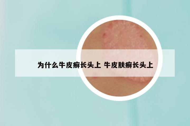 为什么牛皮癣长头上 牛皮肤癣长头上