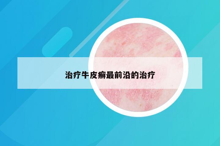 治疗牛皮癣最前沿的治疗
