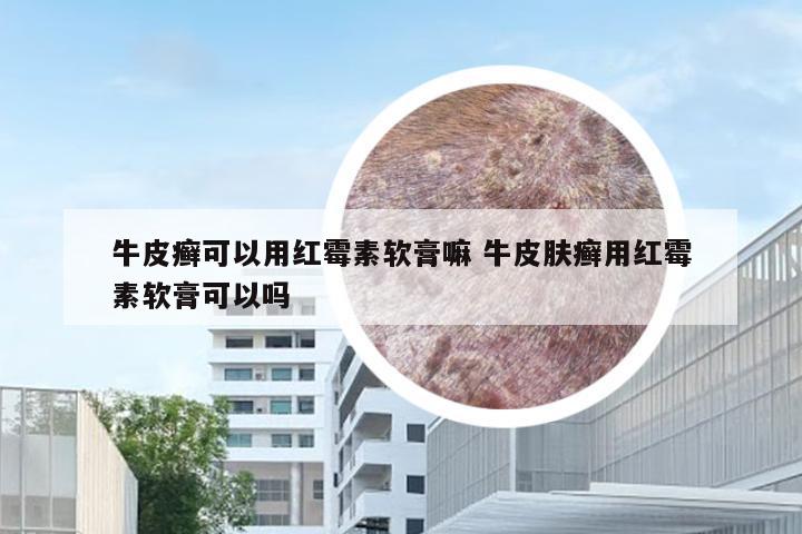 牛皮癣可以用红霉素软膏嘛 牛皮肤癣用红霉素软膏可以吗