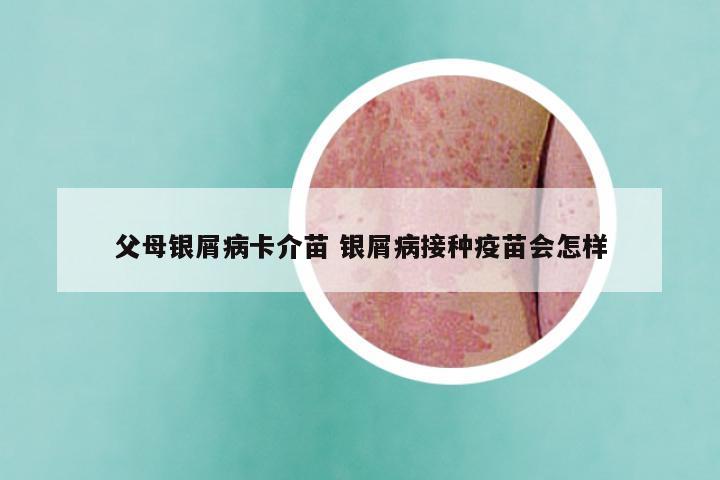 父母银屑病卡介苗 银屑病接种疫苗会怎样