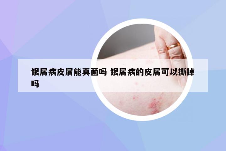 银屑病皮屑能真菌吗 银屑病的皮屑可以撕掉吗