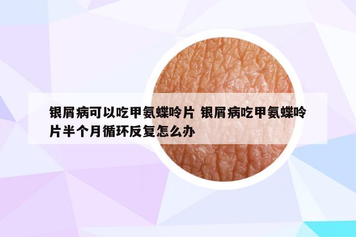 银屑病可以吃甲氨蝶呤片 银屑病吃甲氨蝶呤片半个月循环反复怎么办