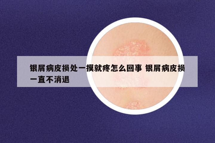 银屑病皮损处一摸就疼怎么回事 银屑病皮损一直不消退