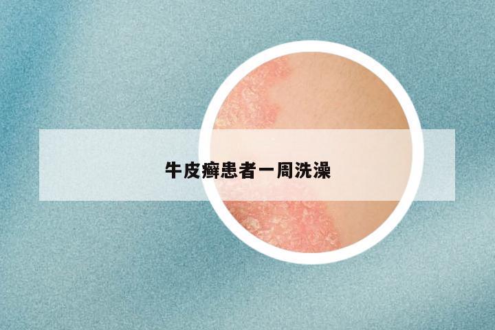 牛皮癣患者一周洗澡