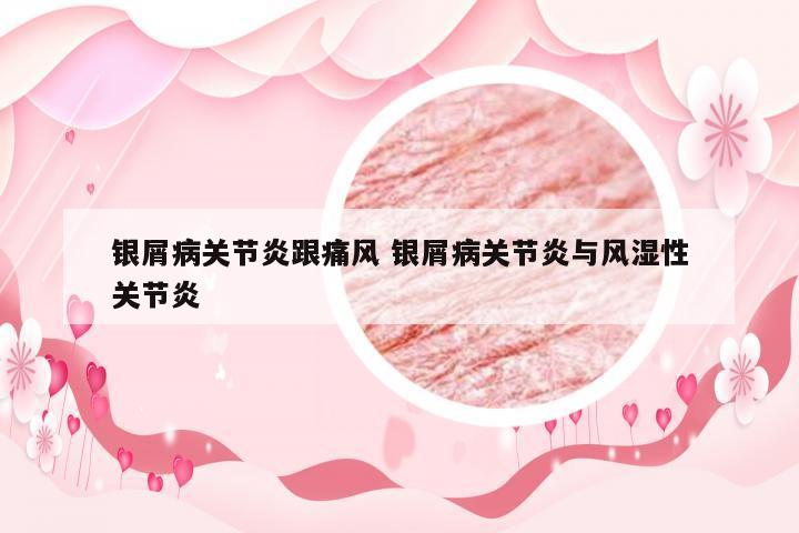 银屑病关节炎跟痛风 银屑病关节炎与风湿性关节炎