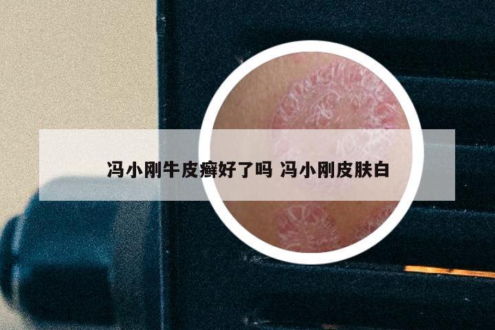 冯小刚牛皮癣好了吗 冯小刚皮肤白
