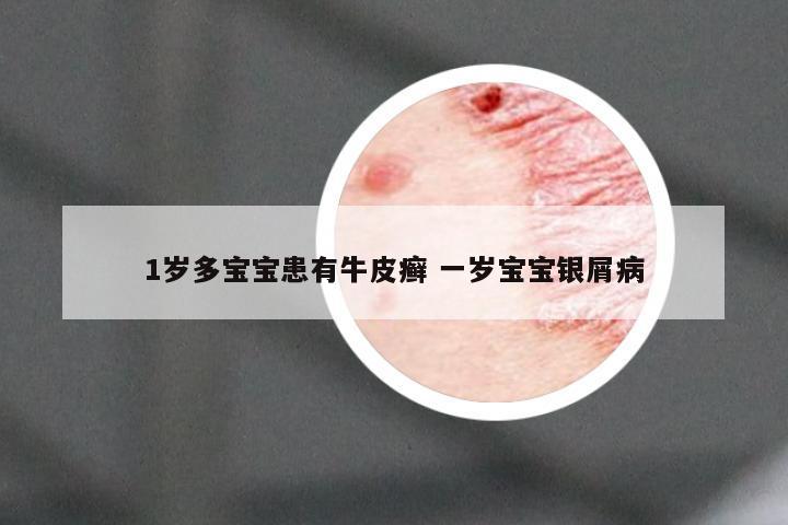 1岁多宝宝患有牛皮癣 一岁宝宝银屑病