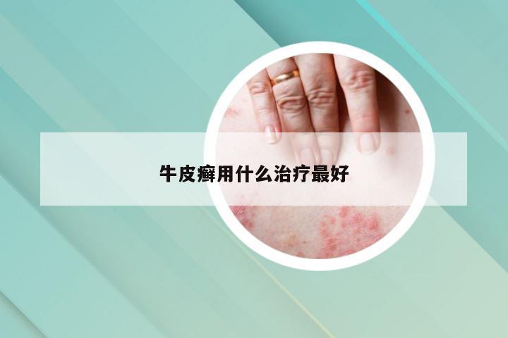 牛皮癣用什么治疗最好