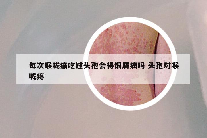 每次喉咙痛吃过头孢会得银屑病吗 头孢对喉咙疼