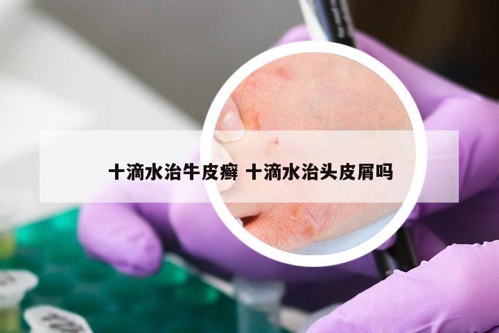 十滴水治牛皮癣 十滴水治头皮屑吗