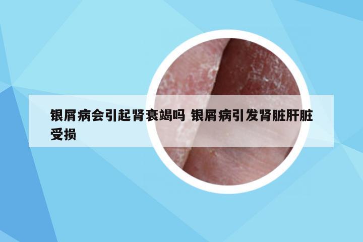 银屑病会引起肾衰竭吗 银屑病引发肾脏肝脏受损