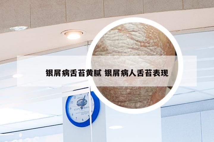 银屑病舌苔黄腻 银屑病人舌苔表现