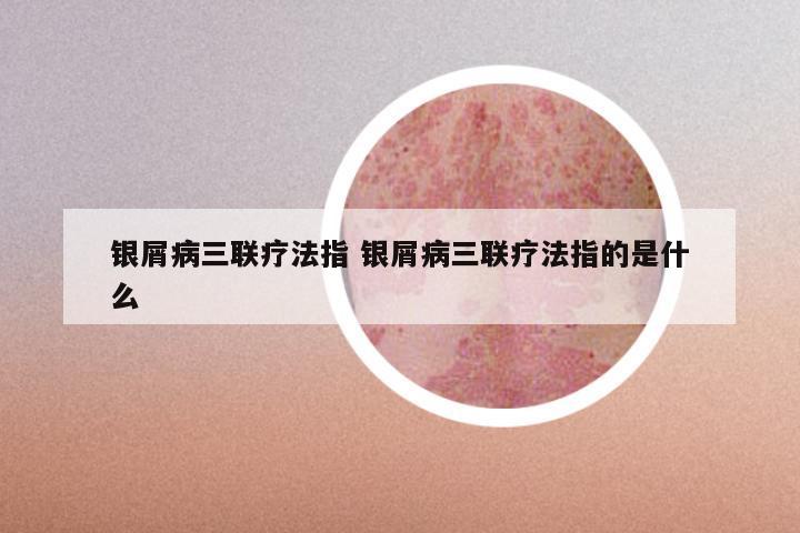 银屑病三联疗法指 银屑病三联疗法指的是什么