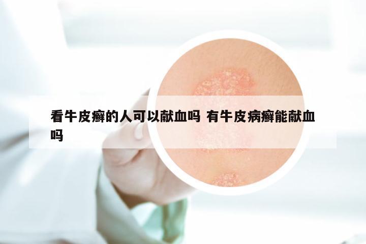 看牛皮癣的人可以献血吗 有牛皮病癣能献血吗