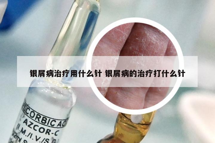 银屑病治疗用什么针 银屑病的治疗打什么针