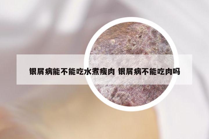 银屑病能不能吃水煮瘦肉 银屑病不能吃肉吗