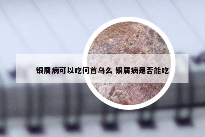 银屑病可以吃何首乌么 银屑病是否能吃