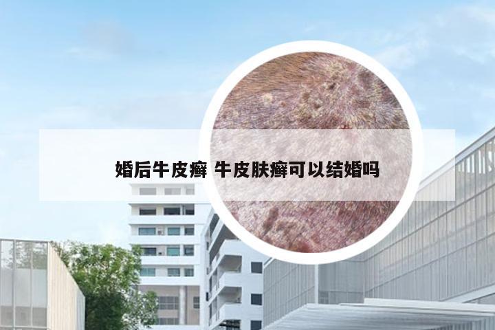 婚后牛皮癣 牛皮肤癣可以结婚吗