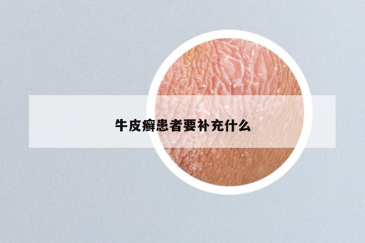 牛皮癣患者要补充什么