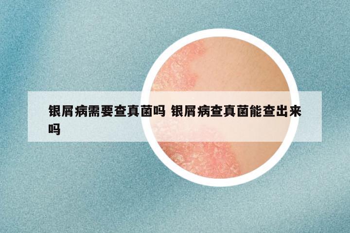 银屑病需要查真菌吗 银屑病查真菌能查出来吗