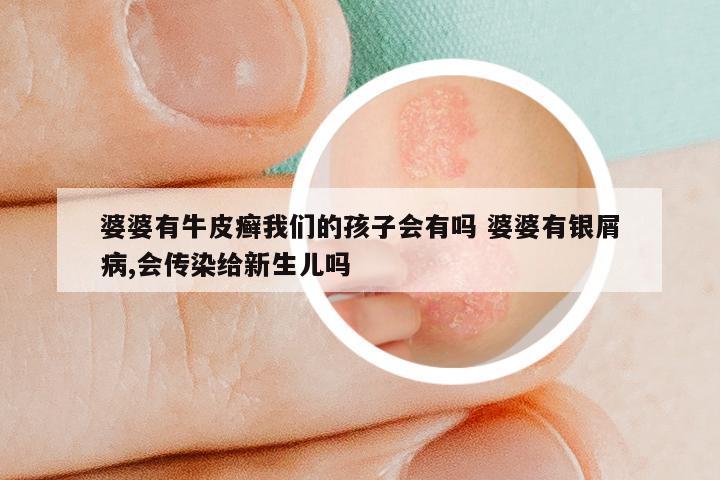 婆婆有牛皮癣我们的孩子会有吗 婆婆有银屑病,会传染给新生儿吗
