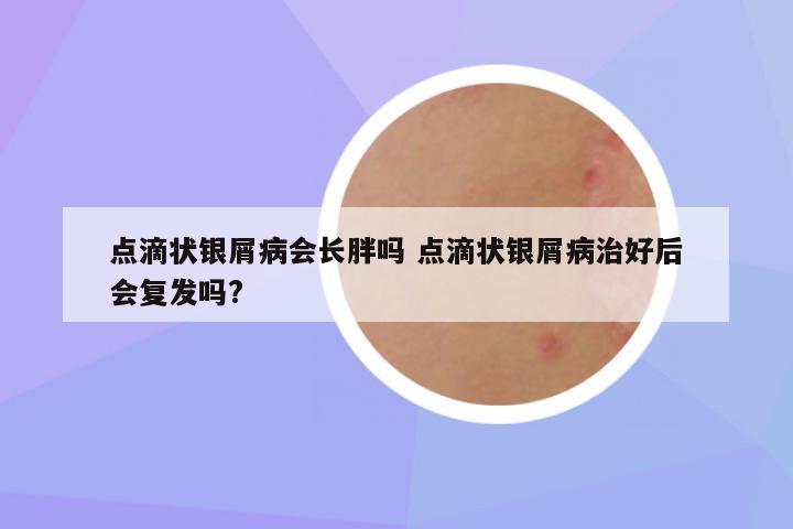 点滴状银屑病会长胖吗 点滴状银屑病治好后会复发吗?
