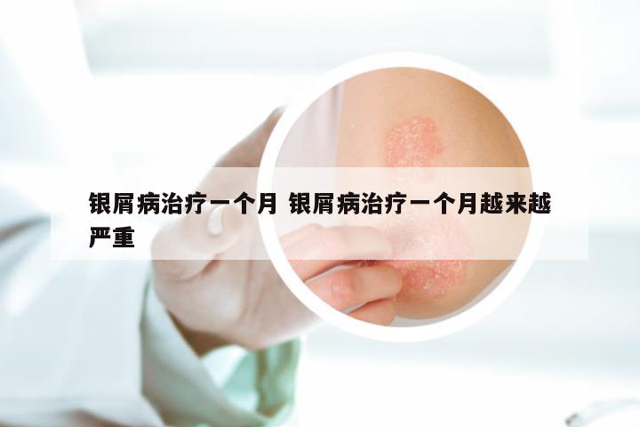 银屑病治疗一个月 银屑病治疗一个月越来越严重