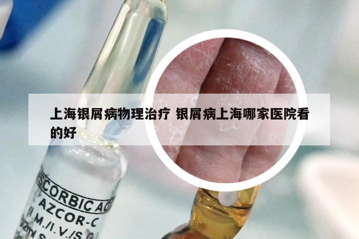 上海银屑病物理治疗 银屑病上海哪家医院看的好
