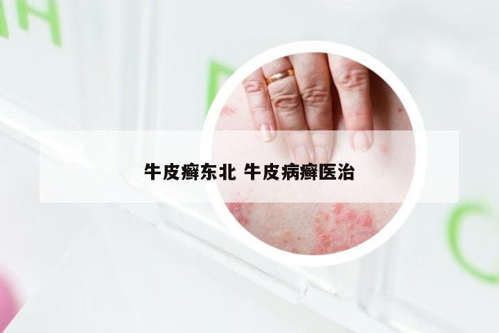 牛皮癣东北 牛皮病癣医治
