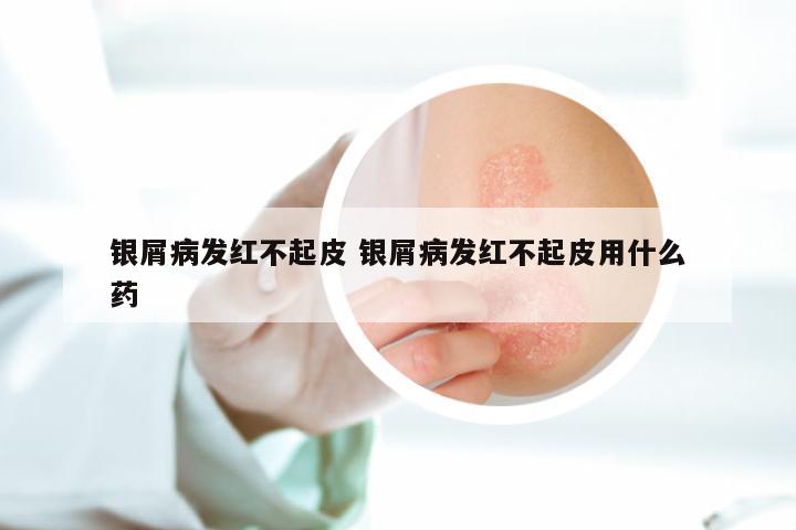 银屑病发红不起皮 银屑病发红不起皮用什么药