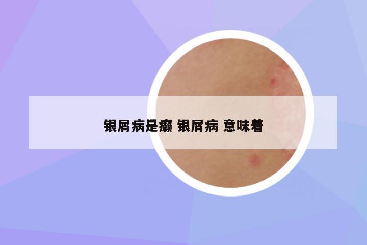 银屑病是癞 银屑病 意味着