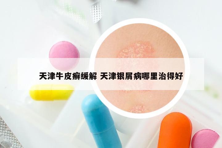 天津牛皮癣缓解 天津银屑病哪里治得好
