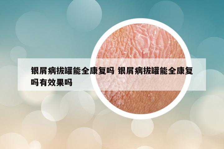 银屑病拔罐能全康复吗 银屑病拔罐能全康复吗有效果吗