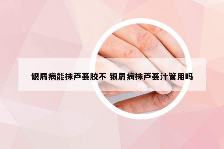 银屑病能抹芦荟胶不 银屑病抹芦荟汁管用吗