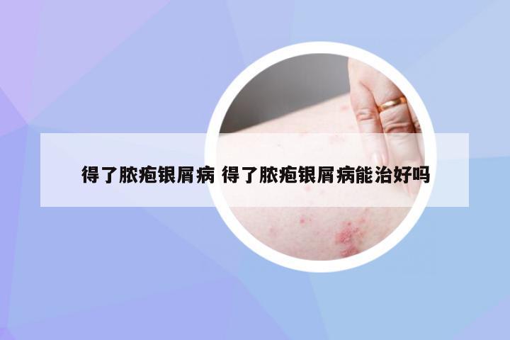 得了脓疱银屑病 得了脓疱银屑病能治好吗