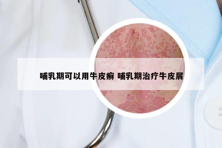 哺乳期可以用牛皮癣 哺乳期治疗牛皮屑