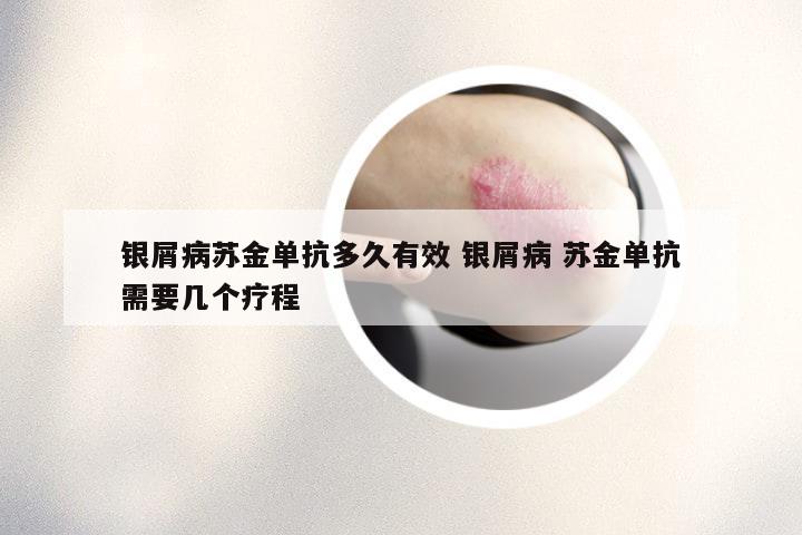 银屑病苏金单抗多久有效 银屑病 苏金单抗需要几个疗程