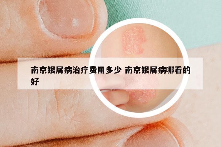 南京银屑病治疗费用多少 南京银屑病哪看的好