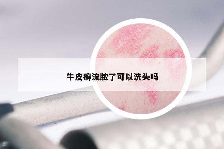 牛皮癣流脓了可以洗头吗