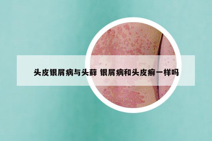 头皮银屑病与头藓 银屑病和头皮癣一样吗
