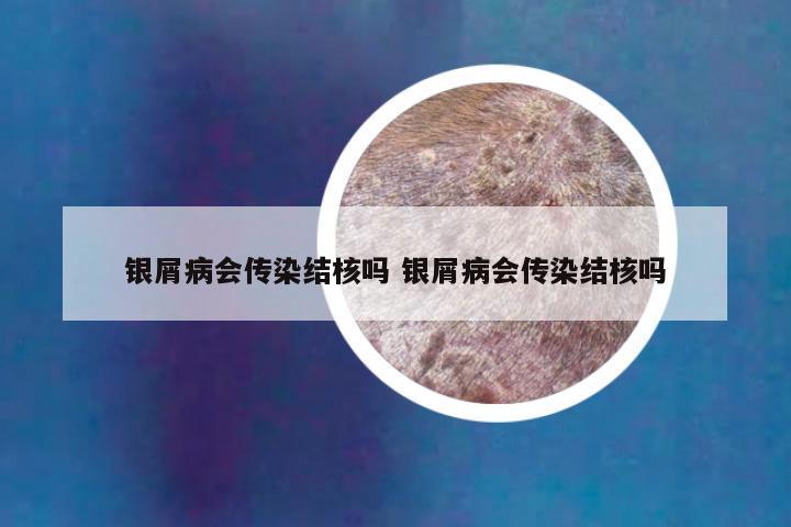 银屑病会传染结核吗 银屑病会传染结核吗