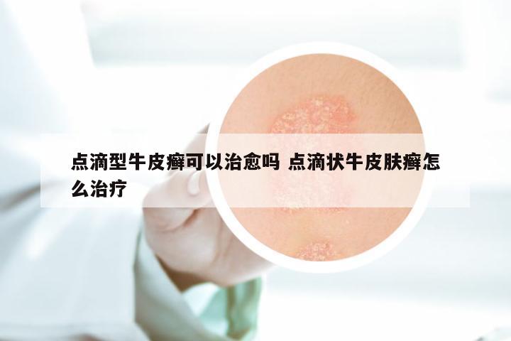 点滴型牛皮癣可以治愈吗 点滴状牛皮肤癣怎么治疗