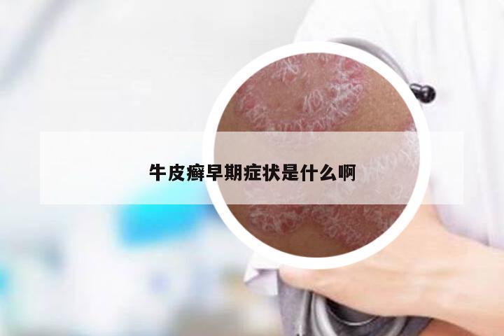 牛皮癣早期症状是什么啊