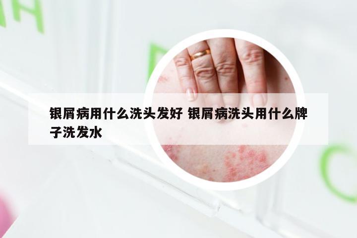银屑病用什么洗头发好 银屑病洗头用什么牌子洗发水