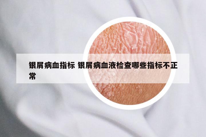 银屑病血指标 银屑病血液检查哪些指标不正常