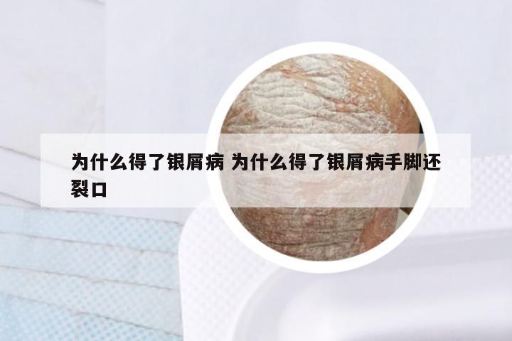 为什么得了银屑病 为什么得了银屑病手脚还裂口