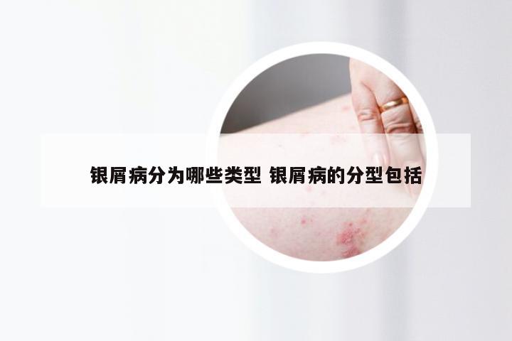 银屑病分为哪些类型 银屑病的分型包括