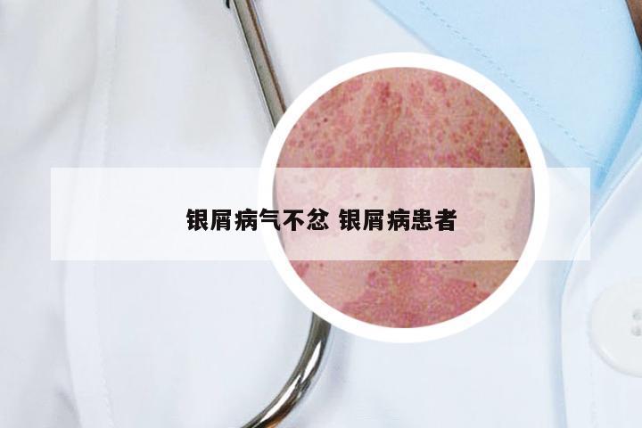 银屑病气不忿 银屑病患者