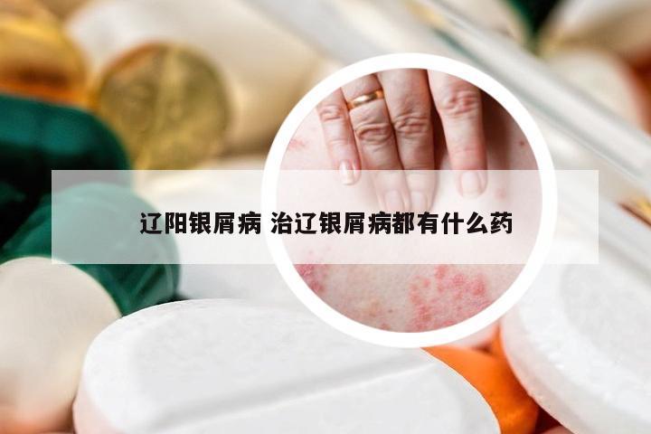 辽阳银屑病 治辽银屑病都有什么药